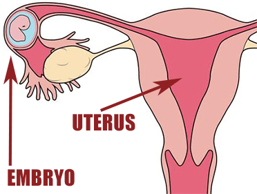 Ectopic pregnancy diagram