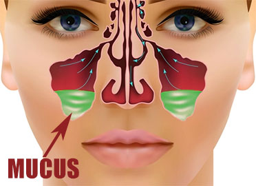 Maxillary sinuses filled with mucus