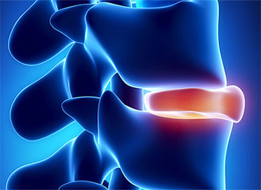 herniated spinal disc